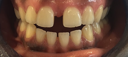 Before and After Invisalign Treatment Wokingham Before and After Invisalign Treatment Wokingham