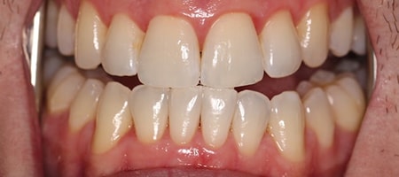 Before and After Invisalign Treatment Wokingham Before and After Invisalign Treatment Wokingham
