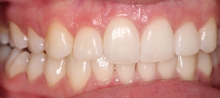 Before and After Invisalign Treatment Wokingham Before and After Invisalign Treatment Wokingham