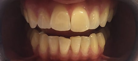 Before and After Invisalign Treatment Wokingham Before and After Invisalign Treatment Wokingham