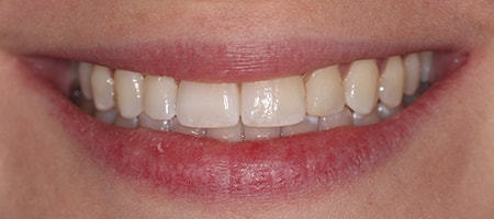 Before and After Invisalign Treatment Wokingham Before and After Invisalign Treatment Wokingham