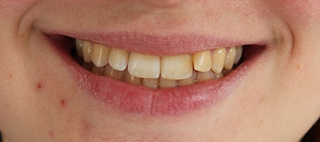 Before and After Invisalign Treatment Wokingham Before and After Invisalign Treatment Wokingham