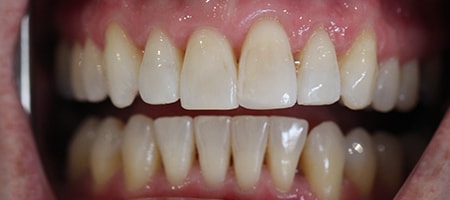 Before and After Invisalign Treatment Wokingham Before and After Invisalign Treatment Wokingham