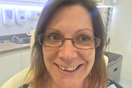 Before and After Invisalign Treatment Wokingham Before and After Invisalign Treatment Wokingham