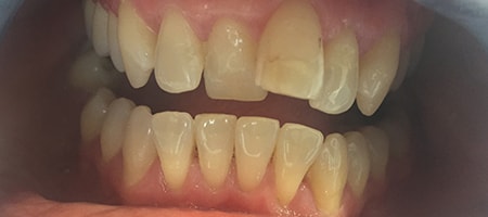 Before and After Invisalign Treatment Wokingham Before and After Invisalign Treatment Wokingham