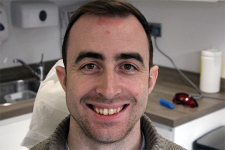 Before and After Invisalign Treatment Wokingham Before and After Invisalign Treatment Wokingham