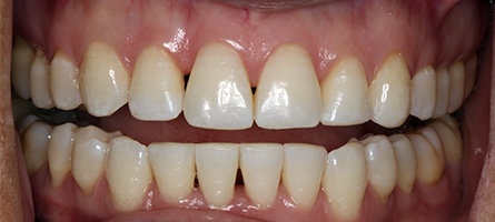 Before and After Invisalign Treatment Wokingham Before and After Invisalign Treatment Wokingham