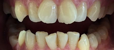 Before and After Invisalign Treatment Wokingham Before and After Invisalign Treatment Wokingham