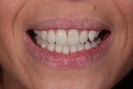 Before and After Invisalign Treatment Wokingham