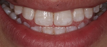 Before and After Invisalign Treatment Wokingham Before and After Invisalign Treatment Wokingham