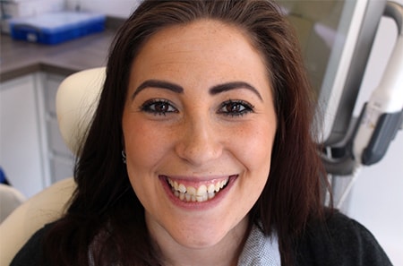 Before and After Bonding Treatment Wokingham