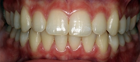 Before and After Invisalign Treatment Wokingham Before and After Invisalign Treatment Wokingham
