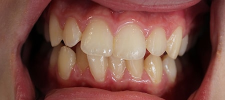 Before and After Invisalign Treatment Wokingham Before and After Invisalign Treatment Wokingham