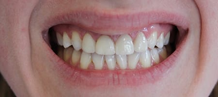 Before and After Invisalign Treatment Wokingham