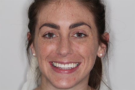 Before and After Invisalign Treatment Kingston Before and After Invisalign Treatment Kingston