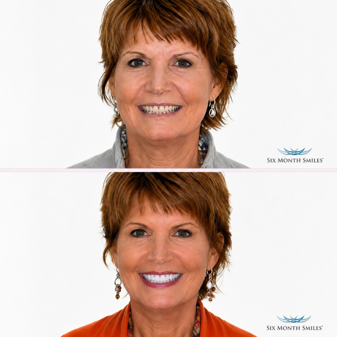 before-after-10