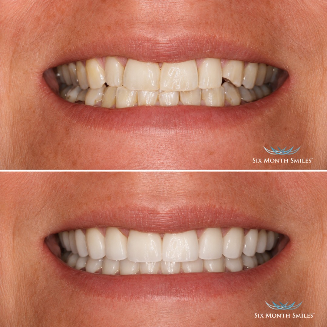 before-after-4