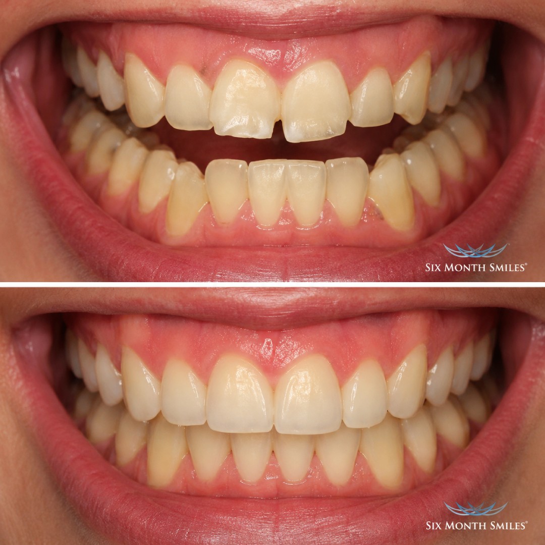 before-after-5