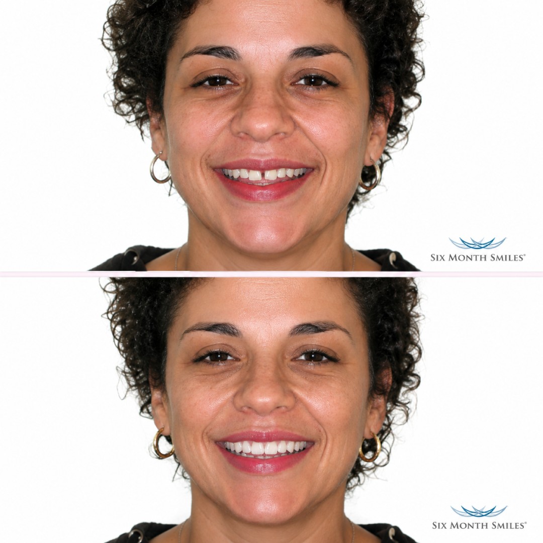 before-after-8