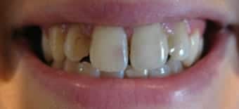 Before veneers Treatment Smile Rooms 