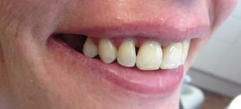 After Veneers Treatment Smile Rooms 