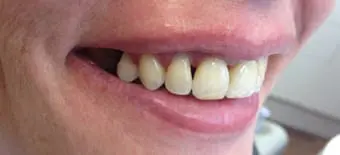 After Veneers Treatment Smile Rooms 