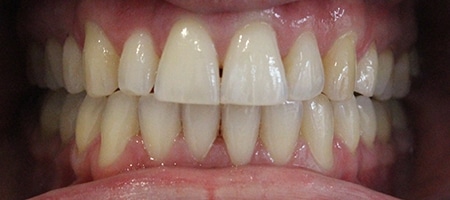 After Invisalign Treatment Reading Smiles 
