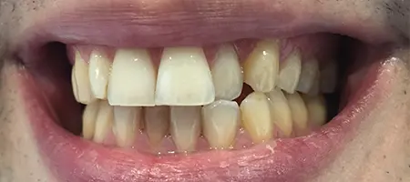 Before Invisalign Treatment Reading Smiles 