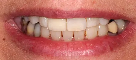 After cosmetic Treatment Smile Rooms 