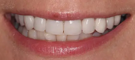 After Veneers Treatment Smile Rooms 