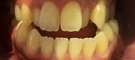 Before Invisalign Treatment Reading Smiles 