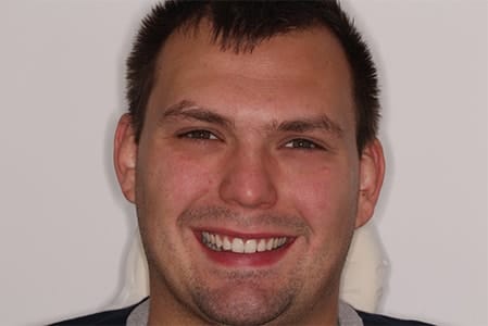 After Invisalign Treatment Reading Smiles 