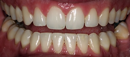 After Invisalign Treatment Reading Smiles 