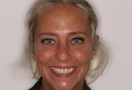 After Invisalign Treatment Reading Smiles 