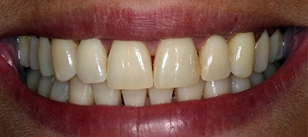 After Invisalign Treatment Reading Smiles 