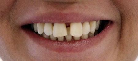 Before Invisalign Treatment Reading Smiles 