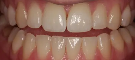 After Invisalign Treatment Reading Smiles 