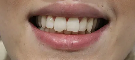 Before Smile Makeover Treatment Smile Rooms 