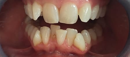 crowded teeth before Invisalign 