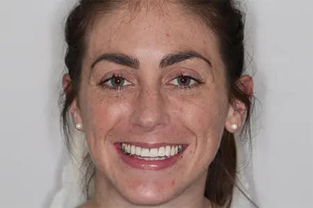 After Invisalign Treatment Reading Smiles 