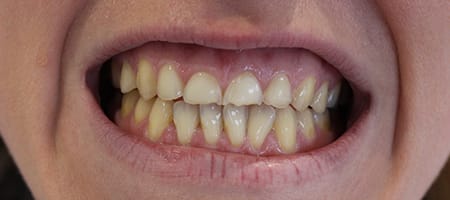 Before veneers Treatment Smile Rooms 